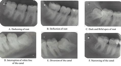 Association of Radiographic Signs in Determining the Proximity of ...