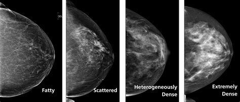 Advice for Breast Cancer Awareness Month: Know Your Breast Density ...