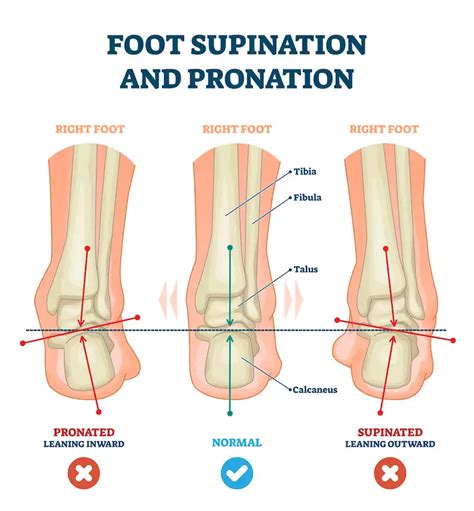 6 Best Exercises To Correct Foot Supination - Feel Good Life