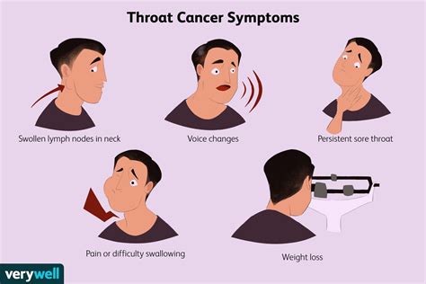 Throat Cancer Signs And Symptoms – NBKomputer