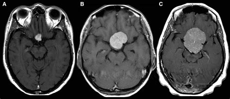 Posts tagged "meningioma" - Neurosurgery Blog