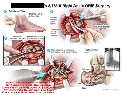 Ankle ORIF Surgery