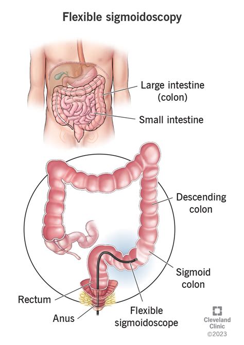 Flexible Sigmoidoscopy: What Is It, Purpose, Prep, vs Colonoscopy