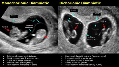 Fetal Twins Ultrasound Normal Vs Abnormal | Monochorionic/Dichorionic ...