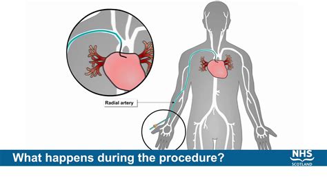 Coronary Angiogram Procedure - YouTube