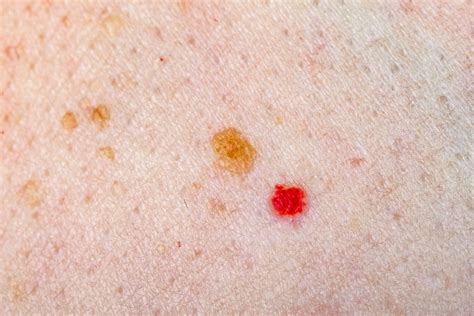 13 Causes of Red Spots on Skin