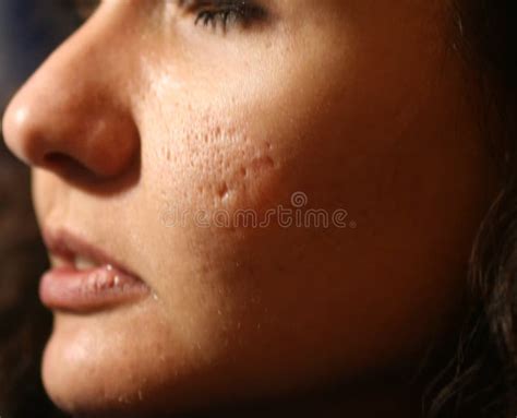 Inflamed Skin of the Face in Pimples and Acne. Keloid Scars from Acne ...