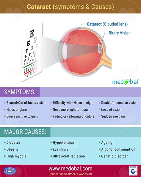 Cataract (Symptoms & Causes) – Medobal – Medium