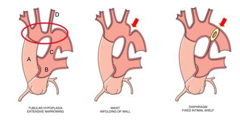 Coarctation of the Aorta : WFSA - Resources