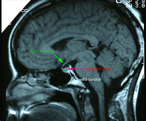 Radiology Anatomy Images : Sella turcica MRI Aantomy