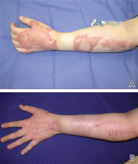 Management of Trauma and Burn Scars: The Dermatologist’s Role in ...