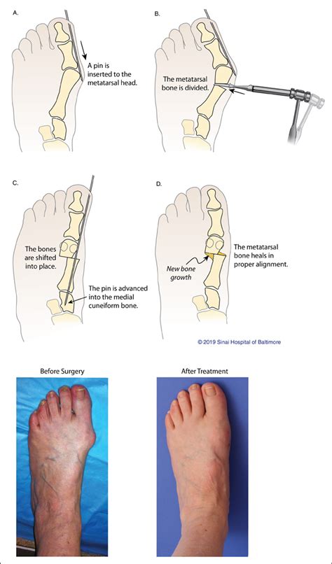 Minimally Invasive Bunion Surgery ... Bunion Surgery, Foot Surgery ...