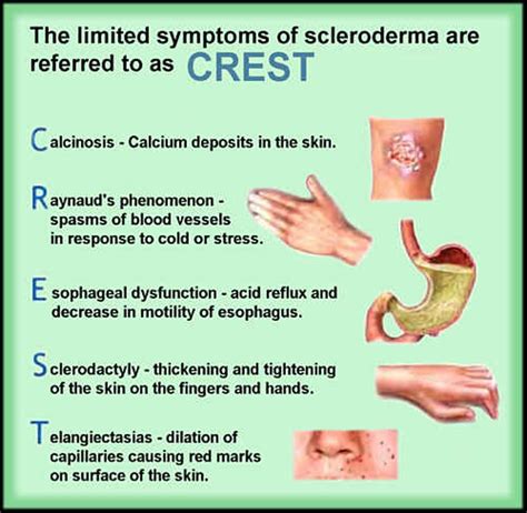 Scleroderma Skin Symptoms