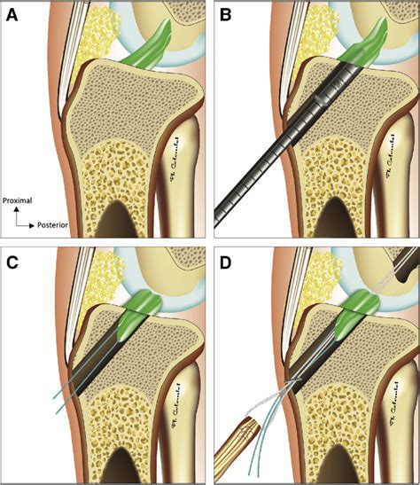 Surgical steps of the technique. (A) Rupture of the ACL. (B) A complete ...