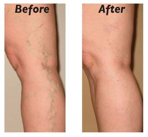 Treatment for Telangiectasia Varicose Veins - Top Varicose Vein ...