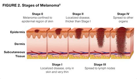 Stages Of Skin Cancer