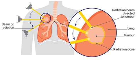 Lung Cancer Radiation Treatment