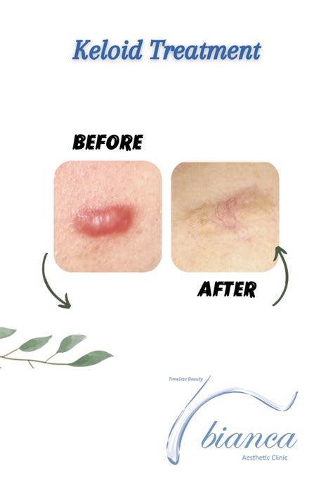 Keloid Treatment - BIANCA AESTHETIC CLINIC