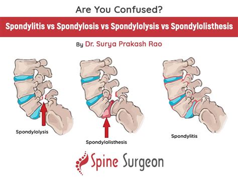 Are You Confused? Spondylitis vs Spondylosis vs Spondylolysis vs ...