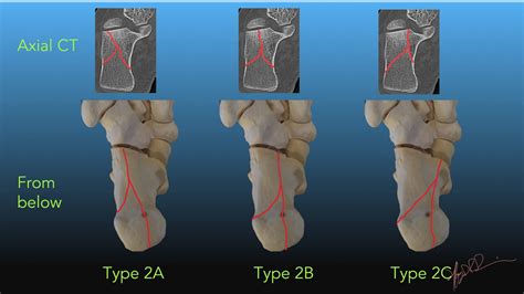 Calcaneus Fracture Classification