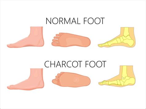 Charcot's Joint: Best 11 Tips To Get Rid Of Naturally