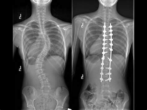 Operate Now! - Scoliosis Surgery - YouTube