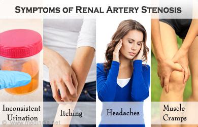 Renal Artery Stenosis (RAS) - Causes, Symptoms, Diagnosis, Treatment ...