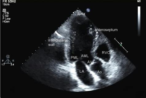 TTE: Transthoracic Echocardiogram - SONOSIF - by SIFSOF, California