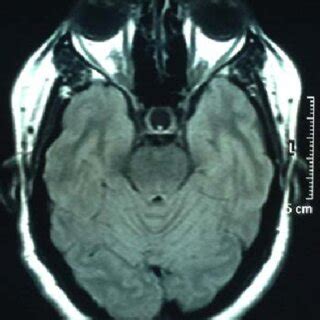 MRI brain (T2 FLAIR-axial) showing empty sella. | Download Scientific ...