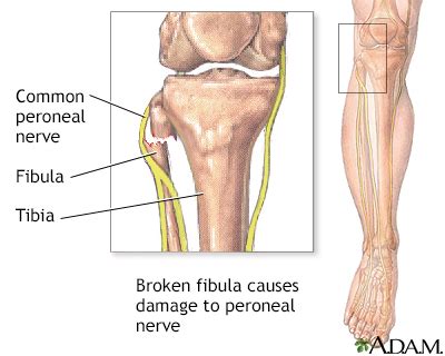 HIE Multimedia - Common peroneal nerve dysfunction