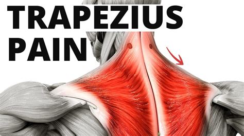 Trapezius Muscle Pain