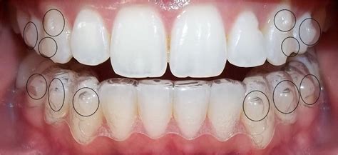 Attachments and Aligners What are Attachments and Aligners? - Velez ...