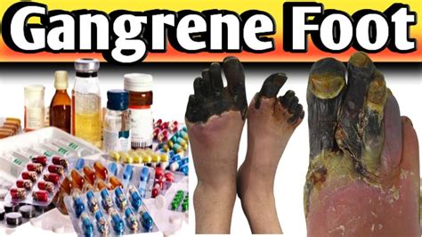 gangrene treatment ||gangrene disease kya hai||gangrene symptoms - YouTube