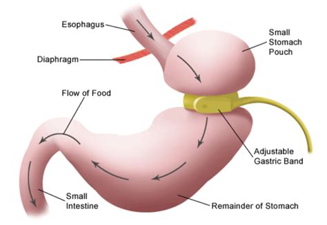 Adjustable Gastric banding - Dr Anastasios Christodoulou