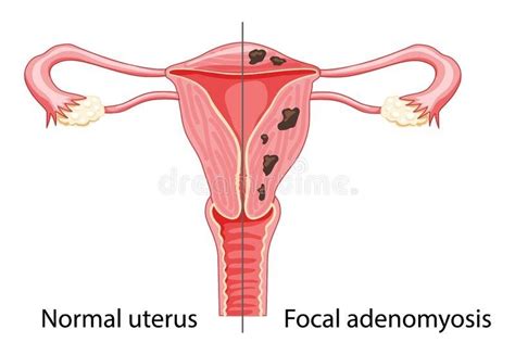 Adenomyosis and Fertility: What You Need to Know to Overcome ...