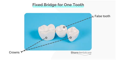 Removable Dental Bridge: Pros & Cons - Share Dental Care