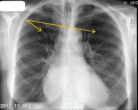 Pulmonary Edema Chest X Ray