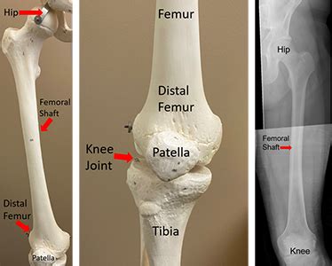 Femoral Shaft Fracture (Thigh Bone Break) | Orthopaedic Trauma ...