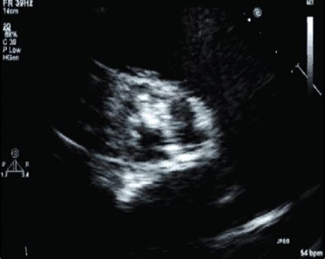 Echocardiographic Assessment of Valvular Heart Disease | Thoracic Key