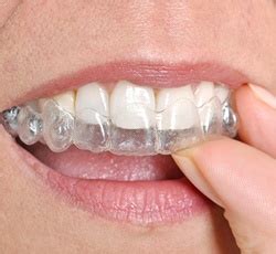 Cost of Invisalign | Lovell Dental