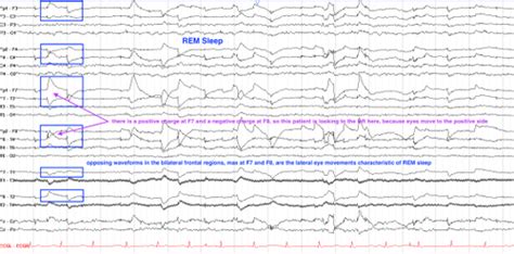 The Normal Asleep EEG