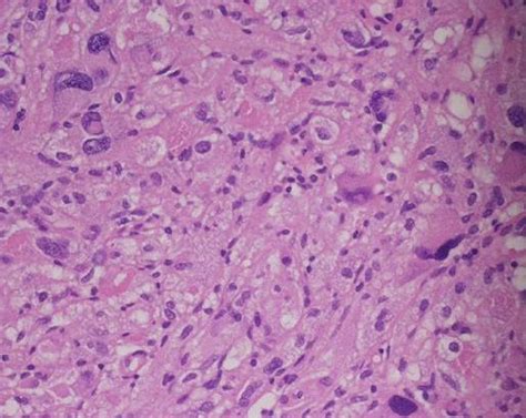 Pleomorphic xanthoastrocytoma | Image | Radiopaedia.org