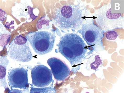 Effusion Cytology | Clinician's Brief