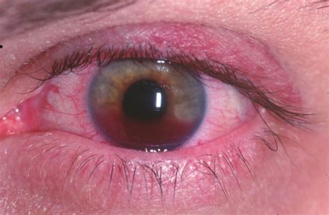 Study Medical Photos: Hyphema - a pooling or collection of blood inside ...