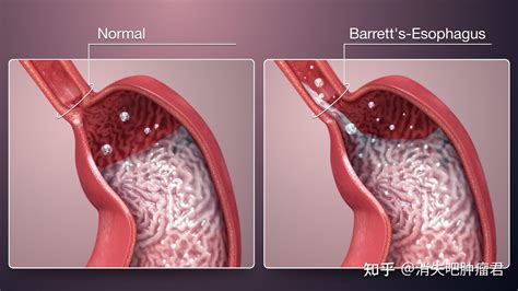 长期烧心，要警惕这个癌前疾病——巴雷特食管（Barrett） - 知乎