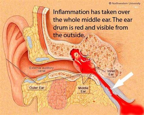 otitis media- what is going on in your head | Ear Infections | Ear ...