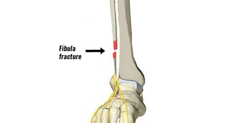 Fibula Fracture - Types, Symptoms, Causes and Rehabilitation