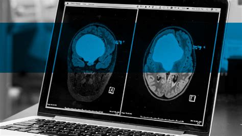 Researchers Seek Novel Craniopharyngioma Treatments | Children's ...