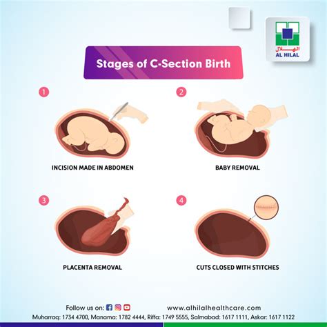 Cesarean Section