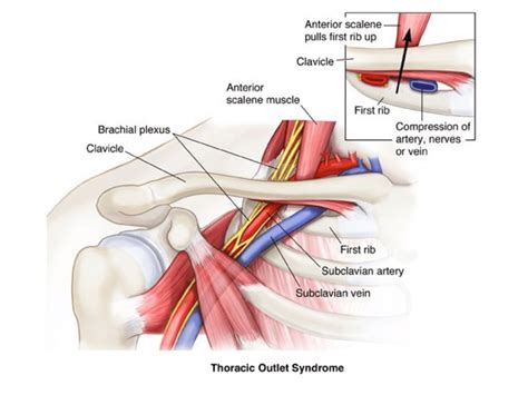 Thoracic Outlet Syndrome | My Vascular Health